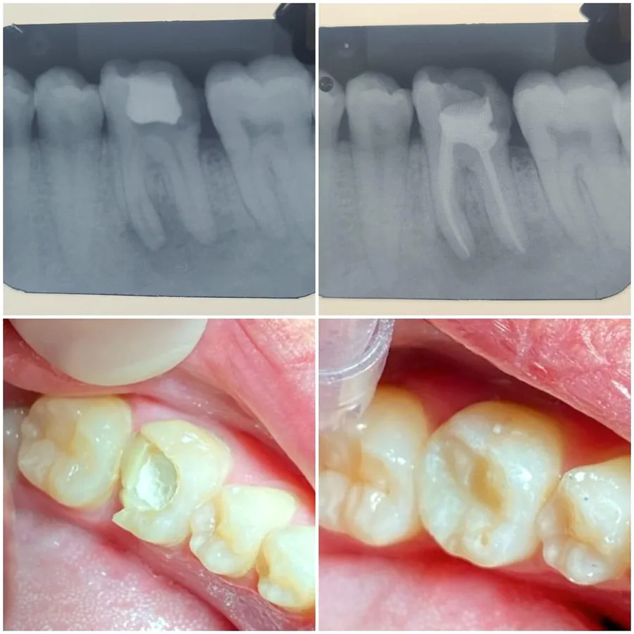 Radiografias e fotos de tratamento de canal com restauração feito em sessão única