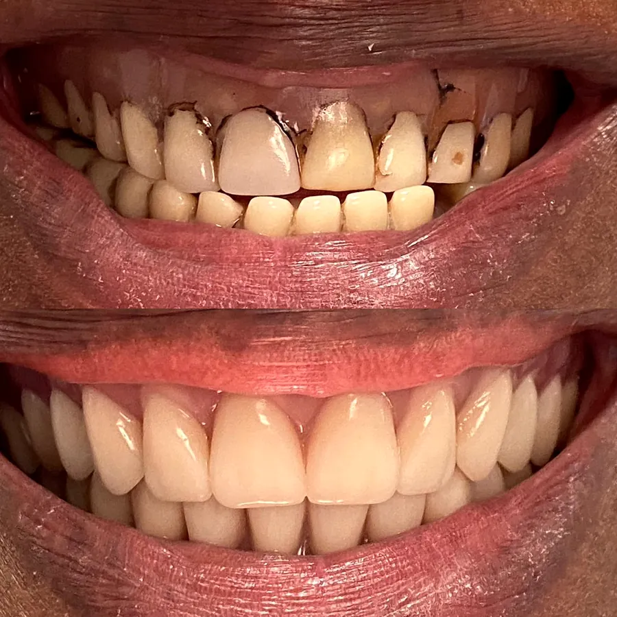 Antes e depois de prótese total superior